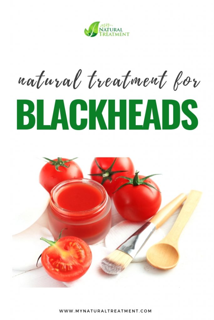 Natural Treatment for Blackheads