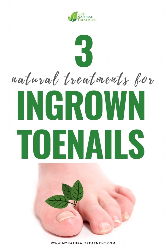 3 Natural Treatments for Ingrown Toenails