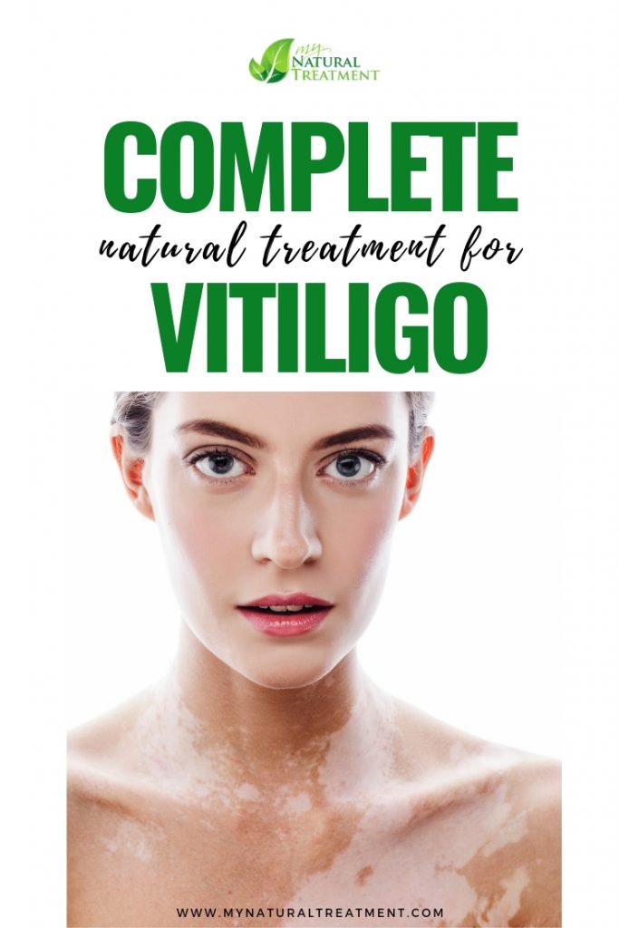 Complete Natural Treatment for Vitiligo