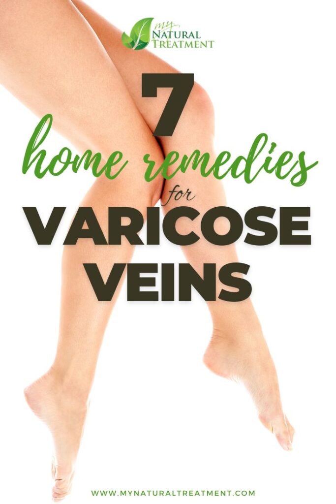 7 Home Remedies for Varicose Veins - MyNaturalTreatment.com