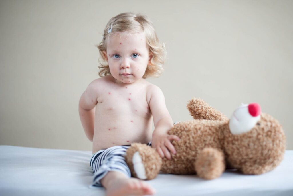 3 Natural Remedies for Measles – Chickenpox