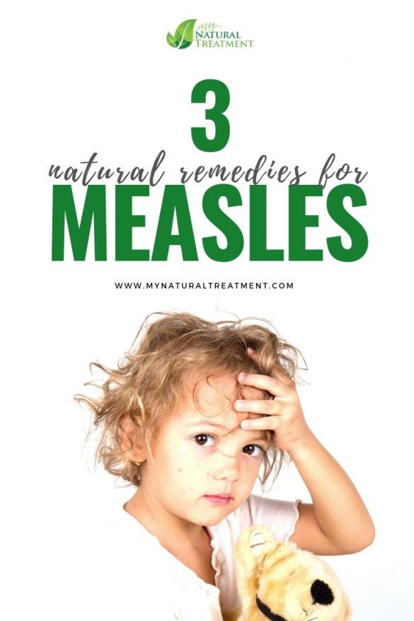 3 Natural Remedies For Measles With Herbs Measles Remedies 