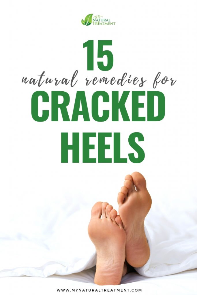 natural remedy Natural Remedies for Cracked Heelsfor cracked heels