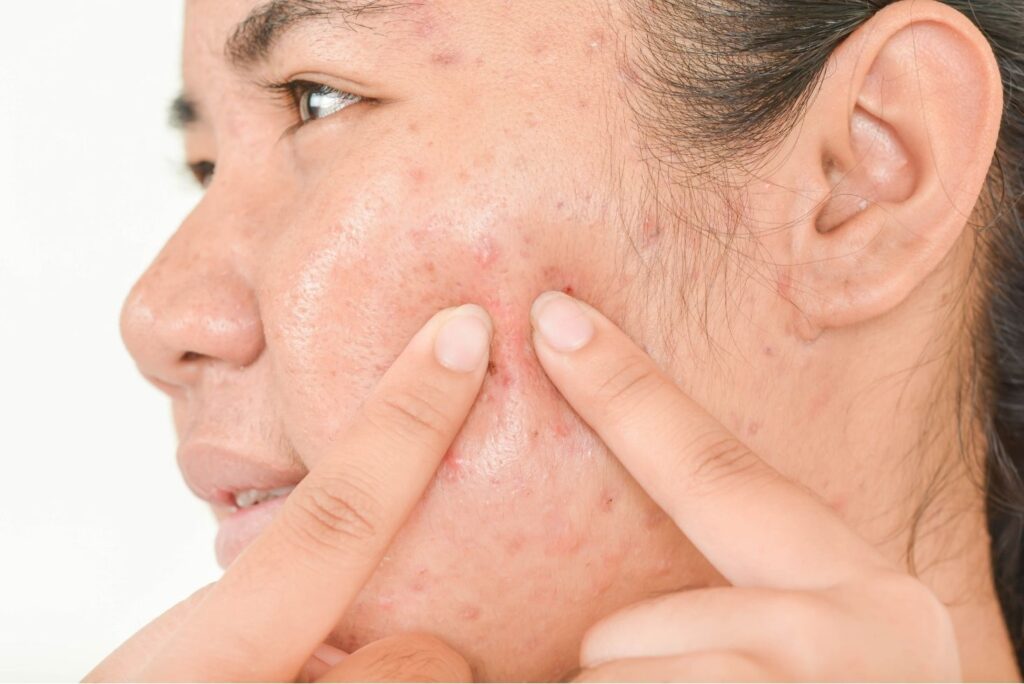 3 Natural Treatments for Cystic Acne - Acne