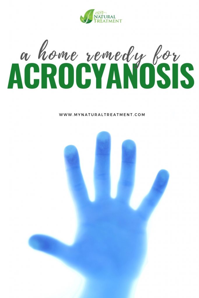 Home Remedy for Acrocyanosis