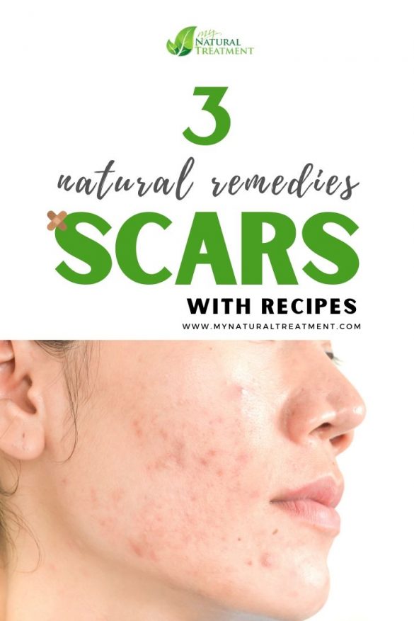 3 Natural Remedies For Scars That Work Scar Tissue 5490