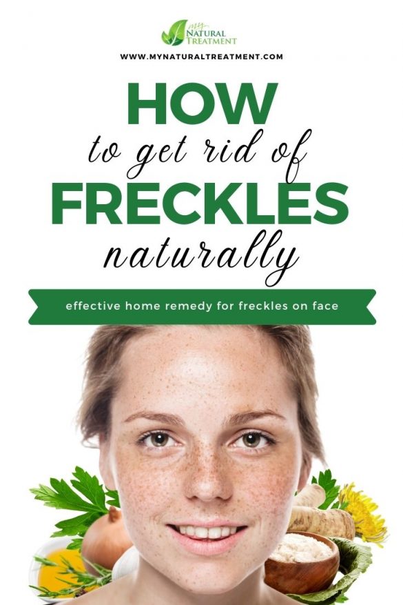 How To Get Rid Of Freckles On Face Naturally 1 Remedy 5637