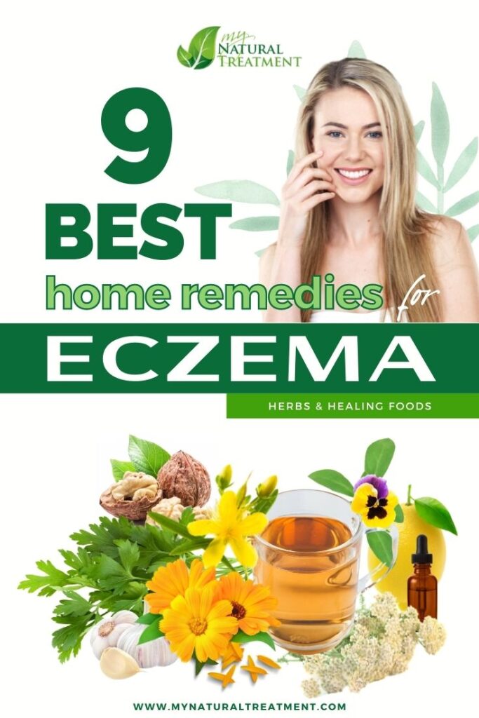 9 Best Home Remedies for Eczema - MyNaturalTreatment.com