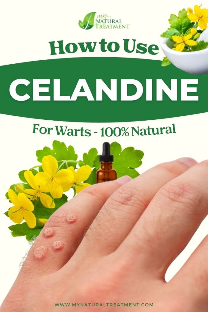 How to Use Celandine for Warts - MyNaturalTreatment.com